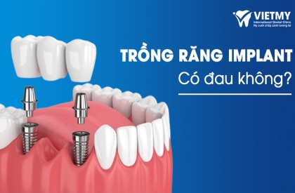 Trồng Răng Implant Có Đau Không? Bật Mí Cách Giảm Sưng Khi Cấy Ghép Implant